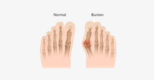Load image into Gallery viewer, 2 Pack: Comfort Healing Toe Separators and Bunion Spacers - FREE SHIP DEALS